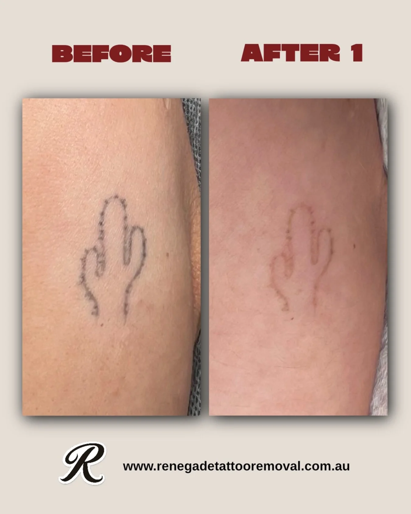 Just did the second and most likely last treatment on this little fine line cactus 🌵

We have a few appointments left for this week - head to the link in our bio to book in now. 

📍 North Perth
📲 0466 022 962
🔗 www.renegadetattooremoval.com.au