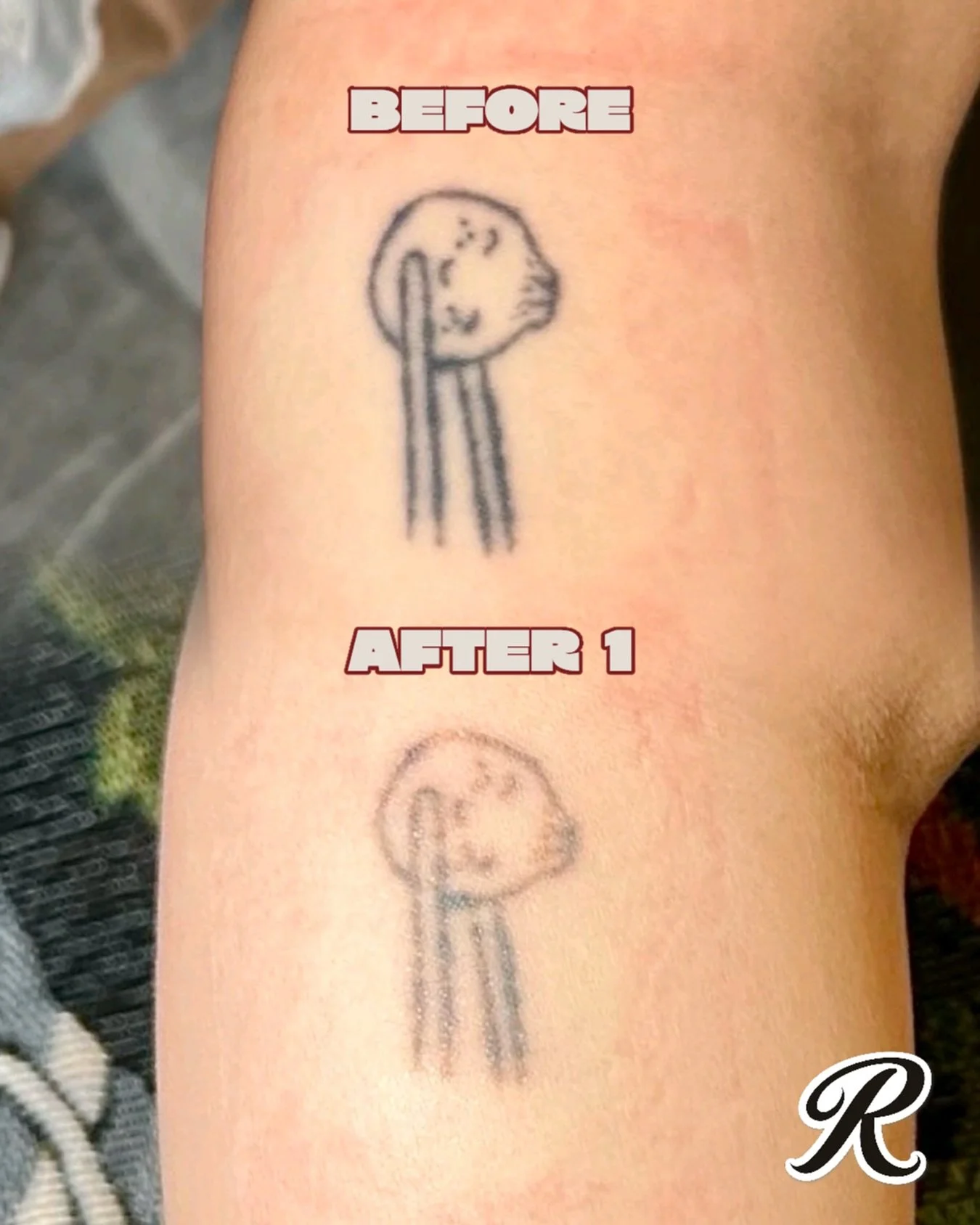 No two removals are the same. 

Things like tattoo location, ink colour, ink depth and skin type all play a role in how quickly a tattoo fades.

This client is already seeing great progress, and we have availability next week if you&rsquo;ve been thi