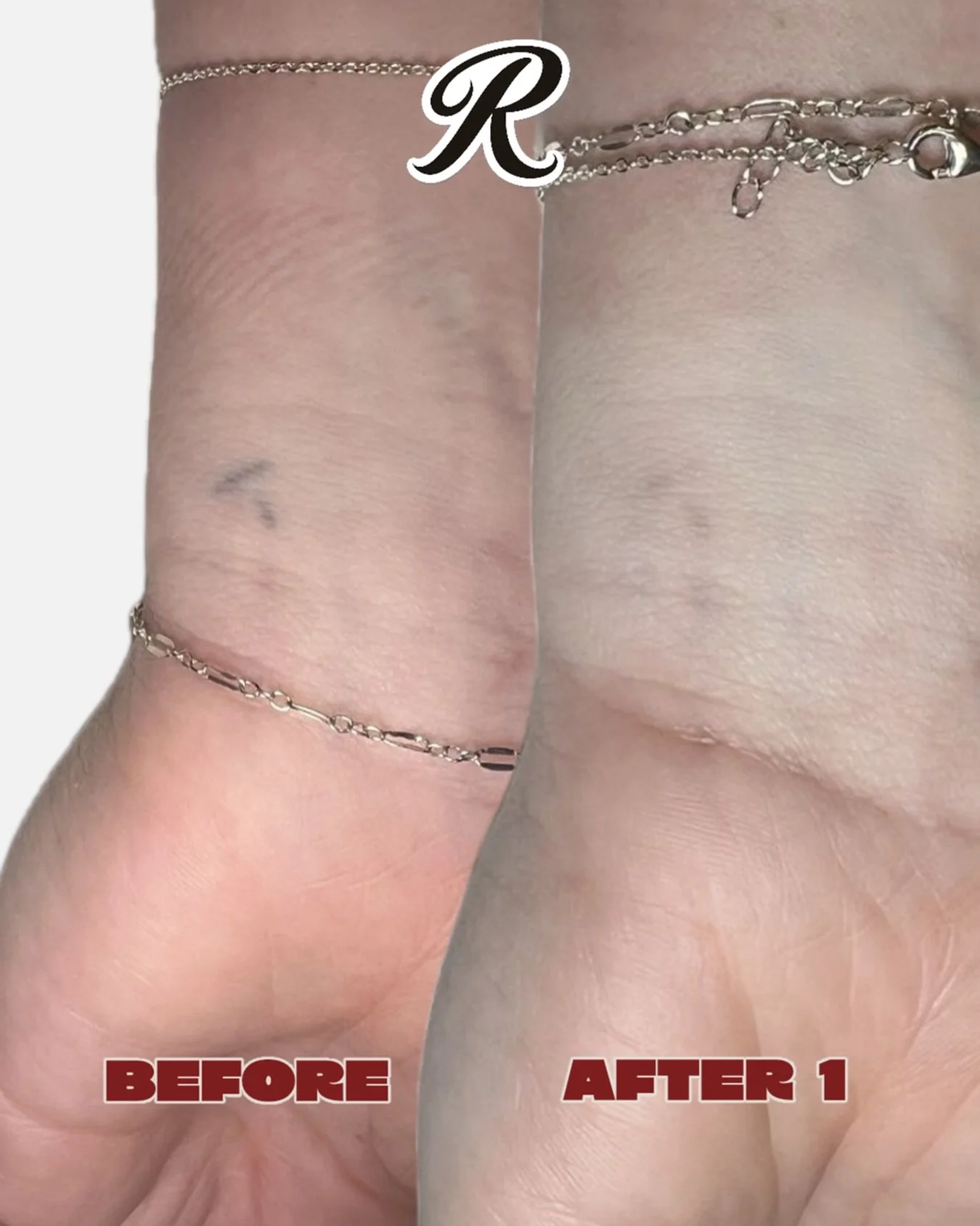 First and last treatment on this little wrist tattoo. The remaining ink will continue to fade in the coming months. 

Winter is the perfect time to begin tattoo removal, and we still have bookings available next week. Head to our bio to book in ✨

📍