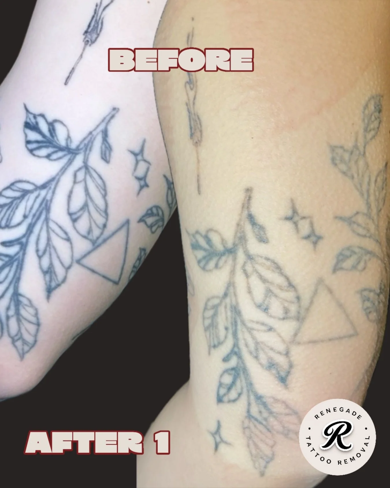 A solid result after treatment number one ✔️

Visit the link in our bio to book in now. 

📍 North Perth | AE Studio
📲 0466 022 962
🔗 www.renegadetattooremoval.com.au