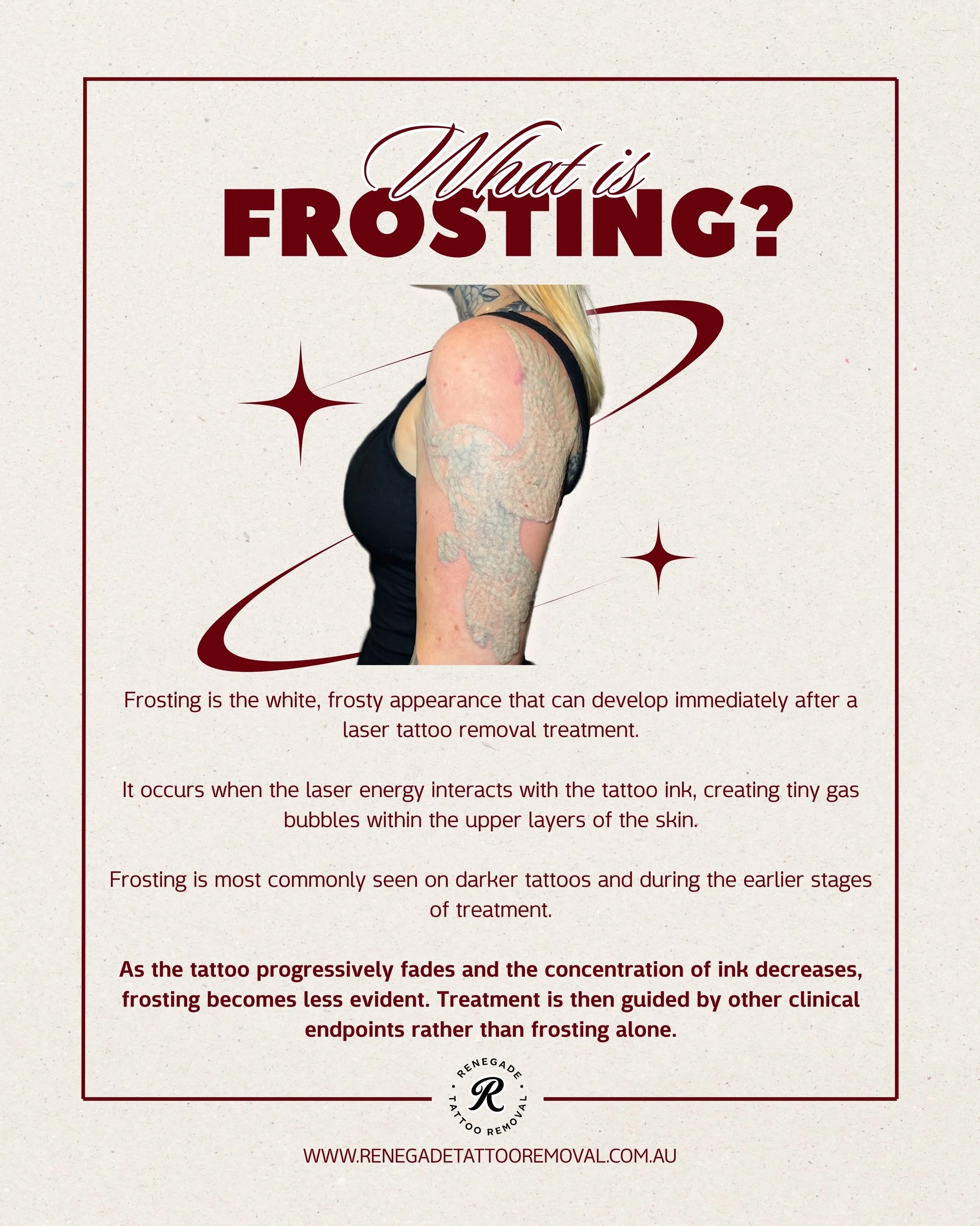 What is frosting? ❄️

Frosting is the white, frosty appearance that can develop immediately after a laser tattoo removal treatment.

It occurs when the laser energy interacts with the tattoo ink, creating tiny gas bubbles within the upper layers of t