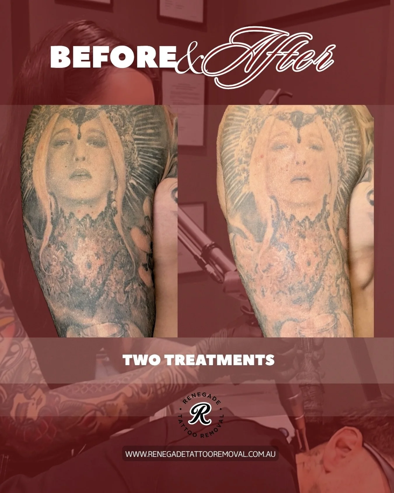 More results rolling in ⚡️

Consistency, patience, and the right treatment plan make all the difference! 

📍 North Perth | AE Studio
📲 0466 022 962
🔗 www.renegadetattooremoval.com.au