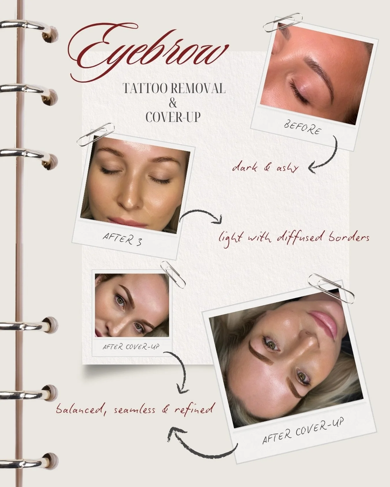 Great cosmetic tattoo cover-ups often start with laser.

By strategically lightening old cosmetic tattooing first, we can create a softer, more neutral base for your cosmetic tattoo artist to work with. This allows for better colour correction, impro