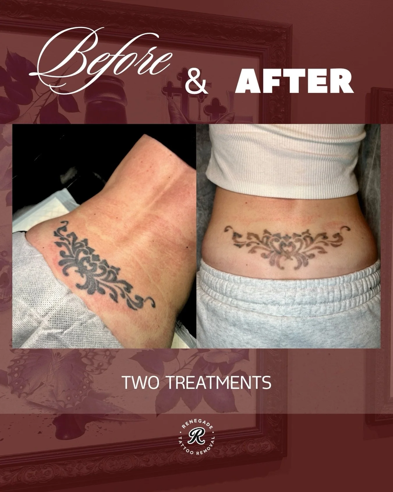 From bold to beautifully faded in just two treatments 😌

A few appointments are still available this week. Secure your spot via the link in our bio.

📍 North Perth | AE Studio
📲 0466 022 962
🔗 www.renegadetattooremoval.com.au