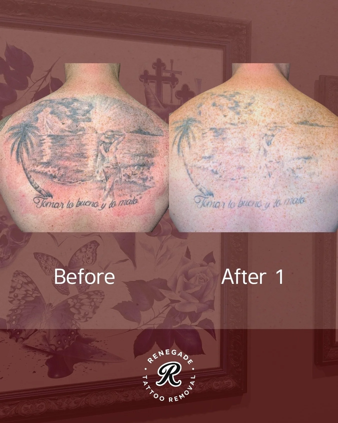 Grey wash tattoos 🤝 laser tattoo removal.

This is the result after just ONE session.

Because grey wash is created using diluted black ink, there&rsquo;s less pigment sitting in the skin compared to heavily saturated blackwork - which make these ta