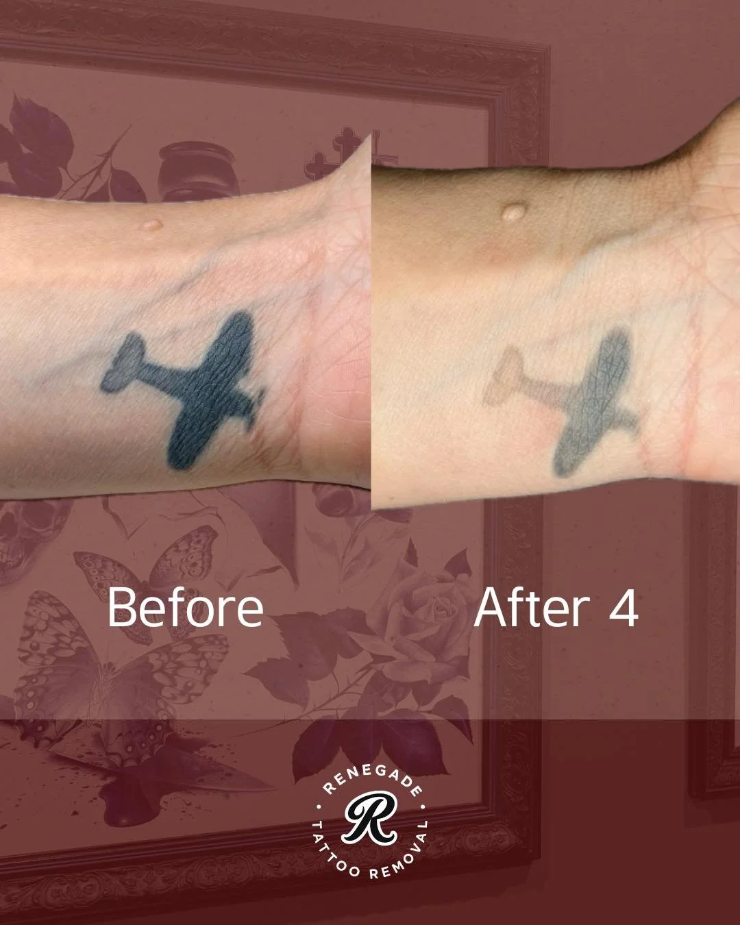 Cover-up removal after 4 sessions 👏

Cover-ups generally mean more ink, more density and multiple layers for the laser to work through - but 4 sessions in and we&rsquo;re already seeing a huge change in this one.

📍 North Perth | AE Studio
📲 0466 