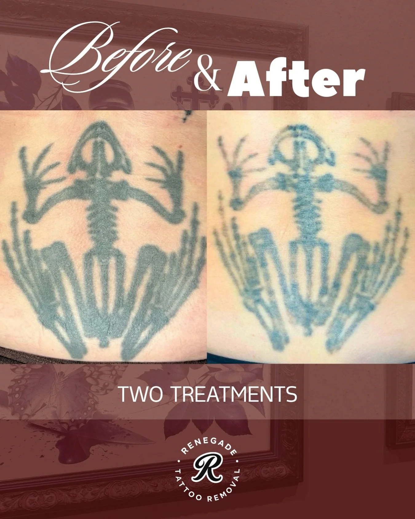 Effective tattoo removal isn&rsquo;t about treating as often as possible - it&rsquo;s about a tailored treatment approach, appropriate spacing between sessions and prioritising the integrity of the skin throughout the process.

After just two treatme