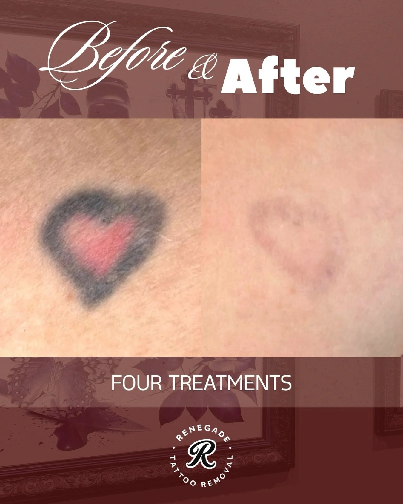 4 treatments on the black 🖤
1 treatment on the red ❤️ 

From a solid little heart to almost a clean slate.

There are only 2 weeks left of our First Birthday Sale. If you&rsquo;ve been thinking about starting your tattoo removal journey, get in quic