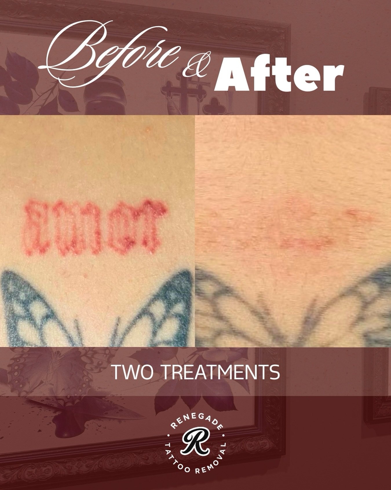 Just finished the final treatment on this back tattoo!

Now we let the body do the rest and see how it&rsquo;s looking in 10 weeks&rsquo; time 😌

📍 North Perth | AE Studio
📲 0466 022 962
🔗 www.renegadetattooremoval.com.au