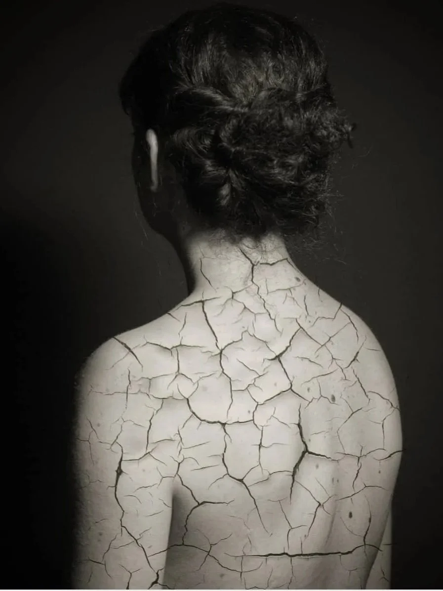 Frozen Shoulder