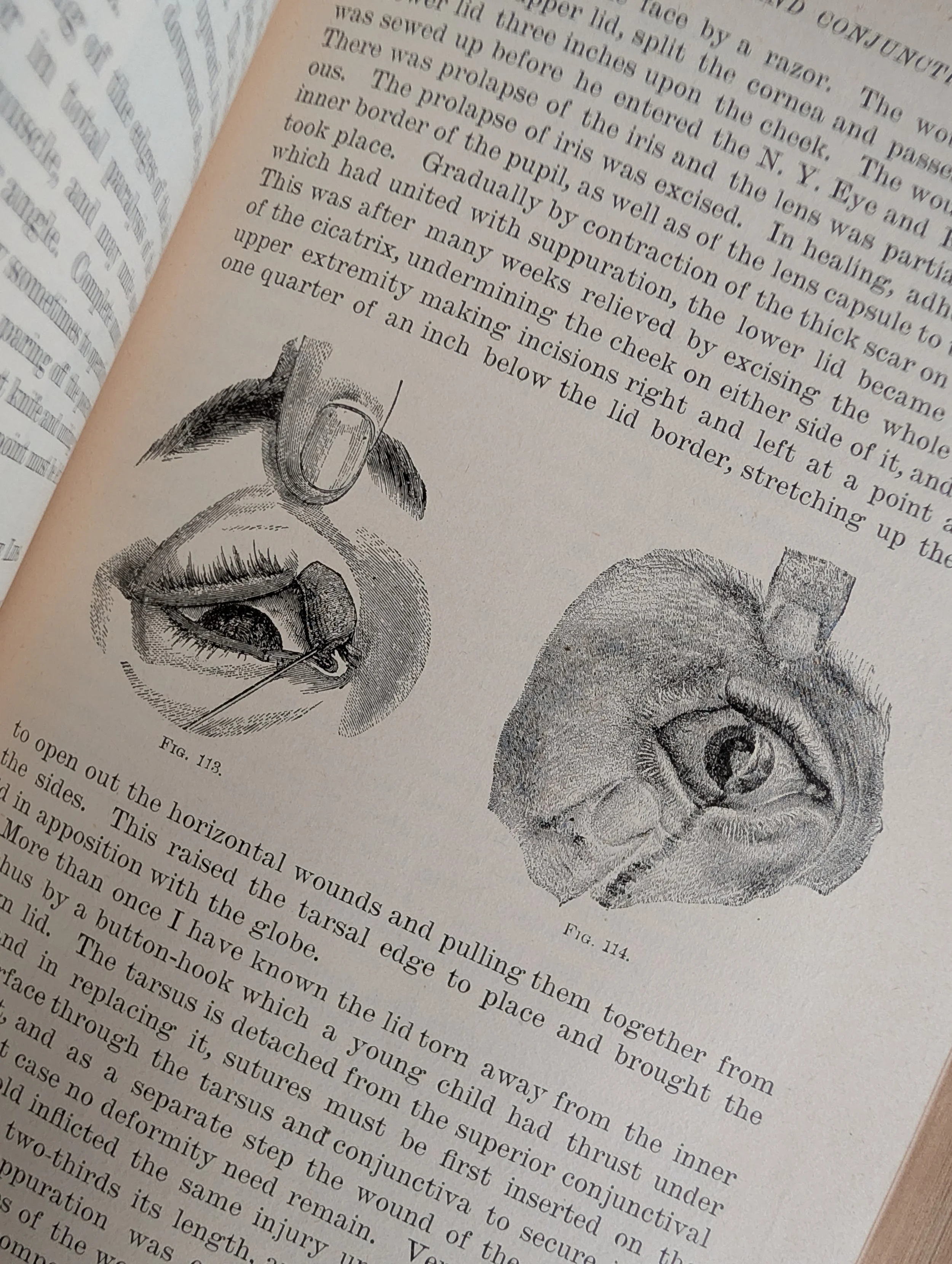 Antique (1894) A Text-Book on Diseases of the eye by Henry D. Noyes - Illustrated.