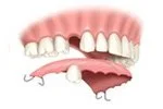 A cartoon illustration of a mouth with missing teeth and a dental implant.