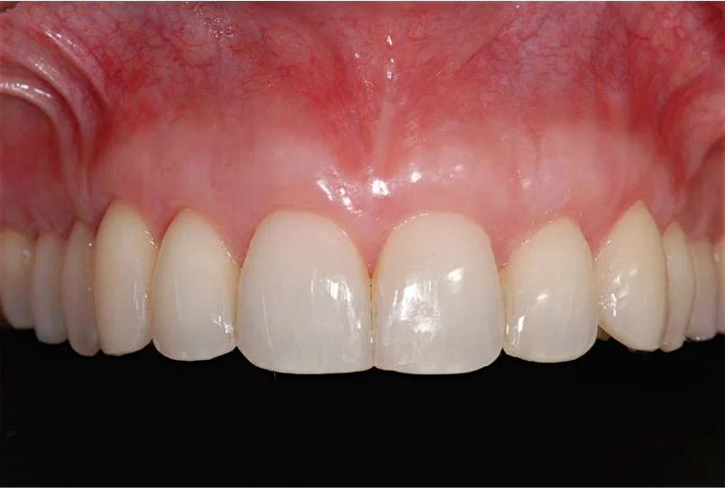 Close-up of upper front teeth and gums, showing healthy, white teeth with a pink gum line.
