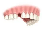 Missing front teeth and dental bridge in lower jaw