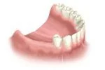 Lower jaw dental model showing teeth and gums