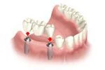Diagram of a dental implant procedure showing a metal post in the jawbone, an artificial tooth attached, and surrounding gums and teeth.