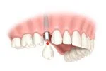 Upper front teeth with a missing tooth replaced by a dental implant or crown