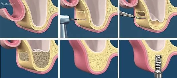 Series of illustrations showing steps in a dental implant procedure: drilling into the jawbone, inserting an implant, attaching an abutment, adding a support device, and placing a crown on the implant.