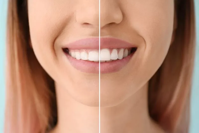 Close-up of a woman’s smile showing her teeth.