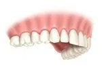 Lower dental arch with missing teeth on the right side and a piece of gum visible.