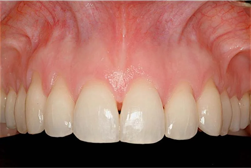 Close-up of upper front teeth and gums showing a small gap between the two front teeth.
