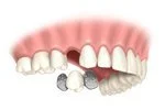 Lower set of teeth with a silver dental filling on one tooth.