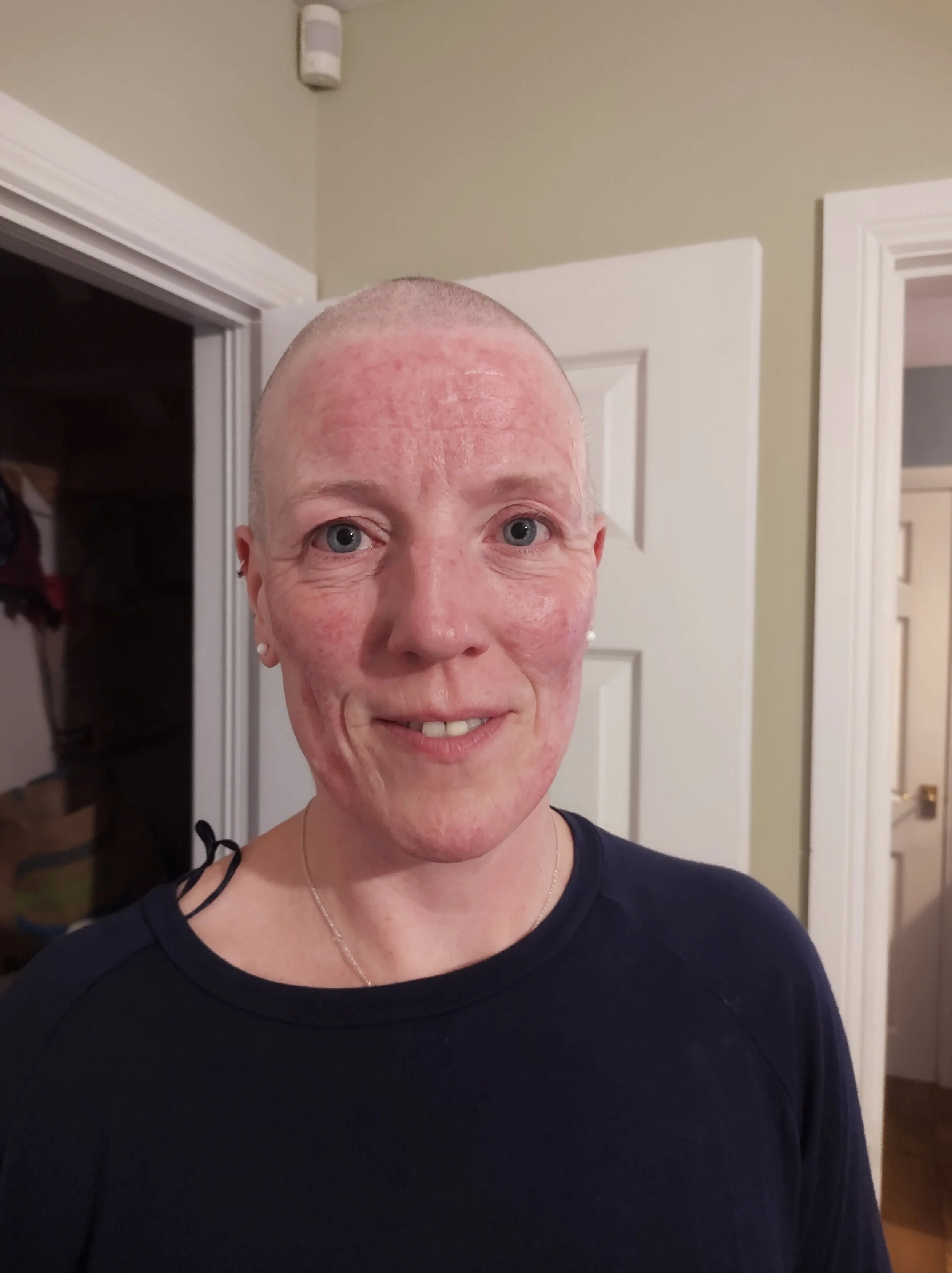 12. The Fallout – Losing My Hair during Chemo