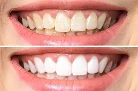 Comparison of a person's teeth before and after teeth whitening, showing an improvement in whiteness and brightness.