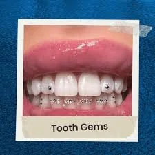 Close-up of a person's open mouth showing teeth with visible dental gems on some teeth.