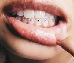 Close-up of a person's mouth with braces on teeth and a finger touching the lower lip.