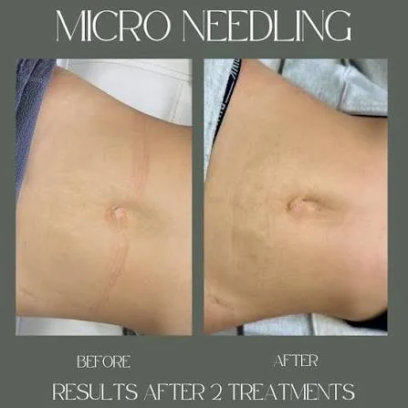 Microneedling Scar & Stretchmark removal + Stem Cell/PRP