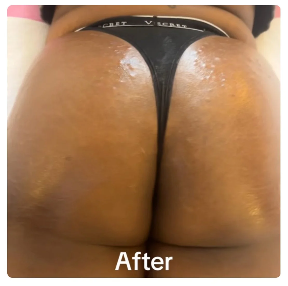 BBL + Spray Tan Bundle (Single Treatment)