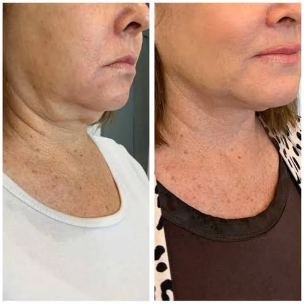 RF Neck & Jawline Sculpt