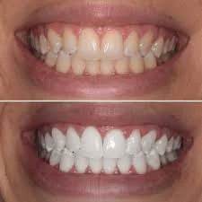 Comparison of a person's teeth before and after dental whitening, showing a shift from stained, yellow teeth to bright white teeth.