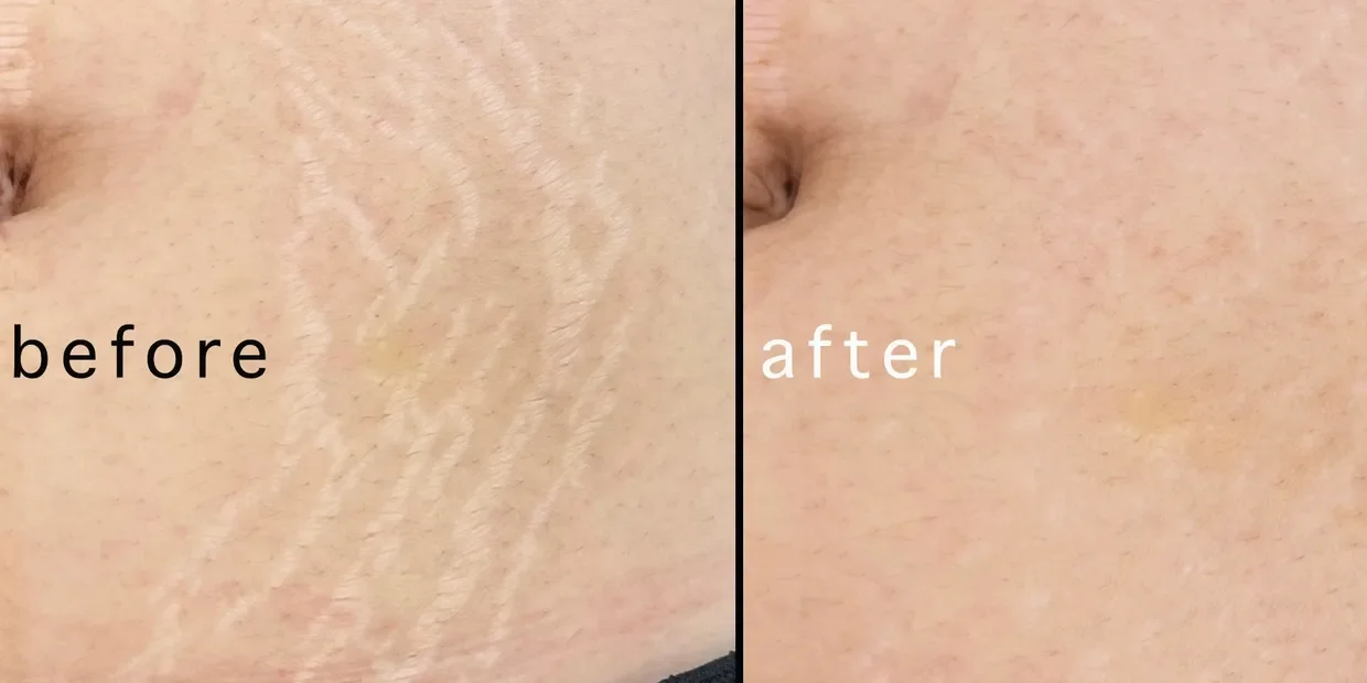 Comparison of skin texture before and after, with noticeable reduction in stretch marks or scars on skin.