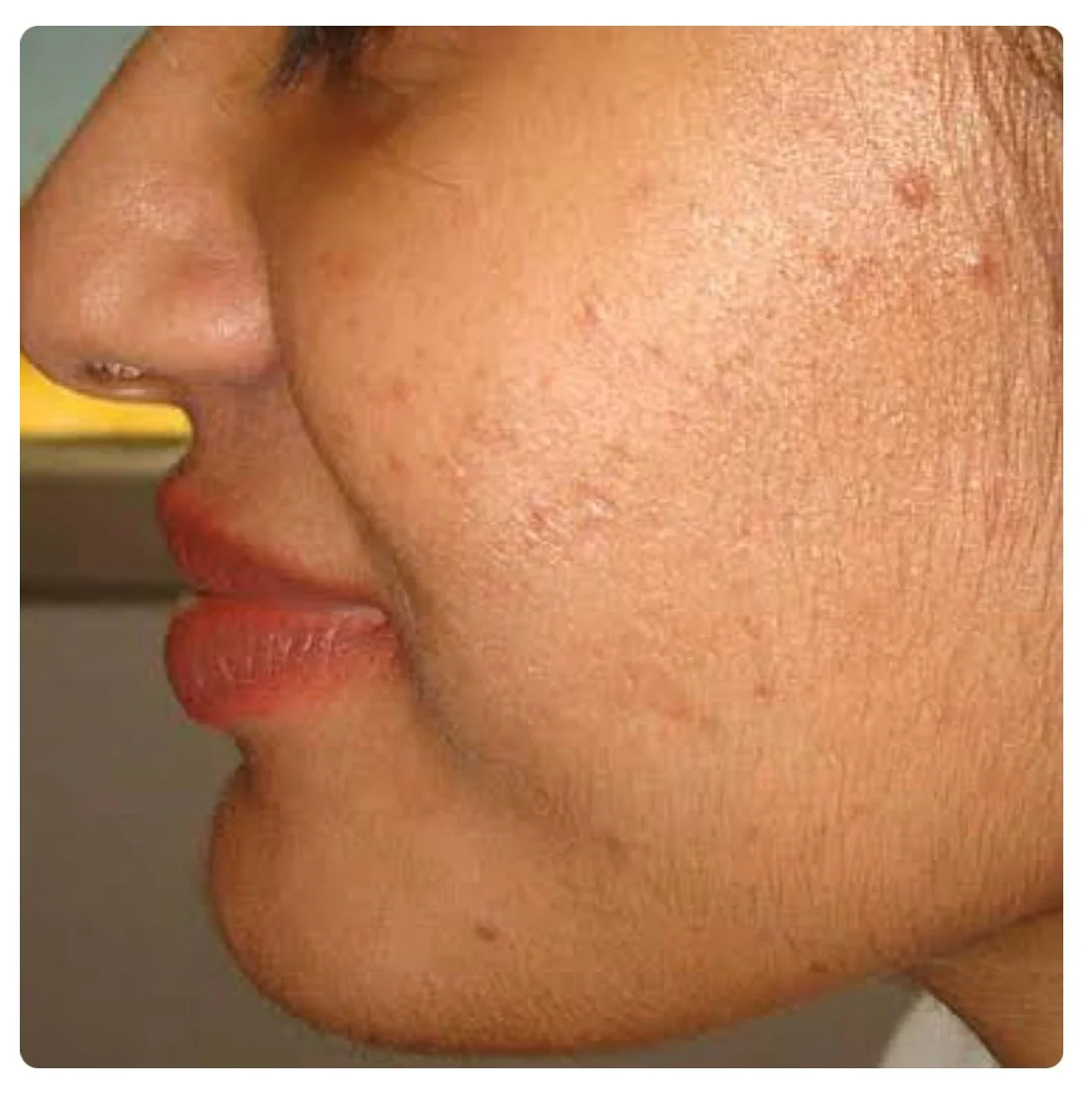 Acne-Clearing Facial  3 Treatments