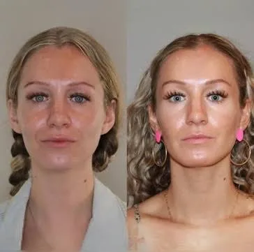 Microneedling Facial+ Stem Cell