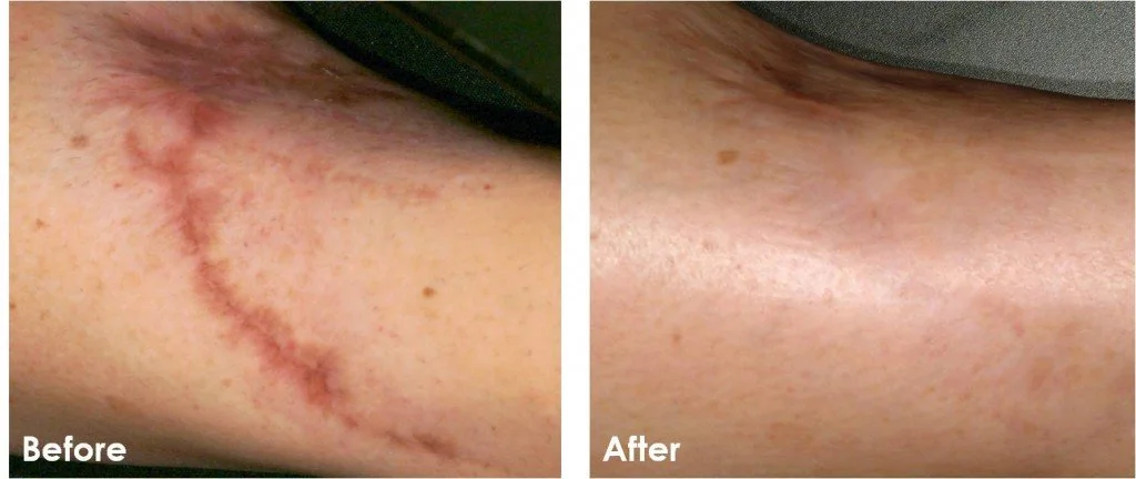 Side-by-side comparison of a skin scar before and after treatment. The 'Before' image shows a prominent, red, curved scar, while the 'After' image displays significantly reduced or faded scar appearance.
