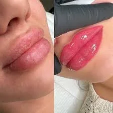 Close-up photos showing a person's lips before and after cosmetic lip enhancement, with the after photo showing fuller, more defined lips.