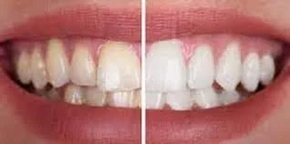 Close-up of a smiling person's teeth, showing a before-and-after comparison of teeth whitening or dental treatment.
