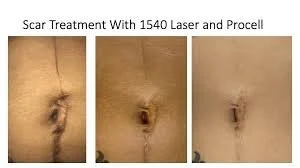 Three side-by-side photos showing the progression of a scar near the abdomen, from initial wound to healed stage after treatment with 1540 laser and Procell. The images depict the scar becoming less visible over time.