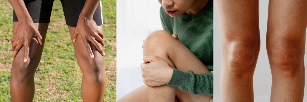 Children’s Leg Pain/Growing Pains: Benign Nocturnal Limb Pains vs Apophysitis