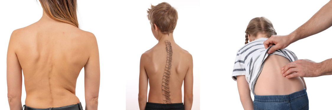 Understanding Scoliosis in Children: What Parents Should Look Out For