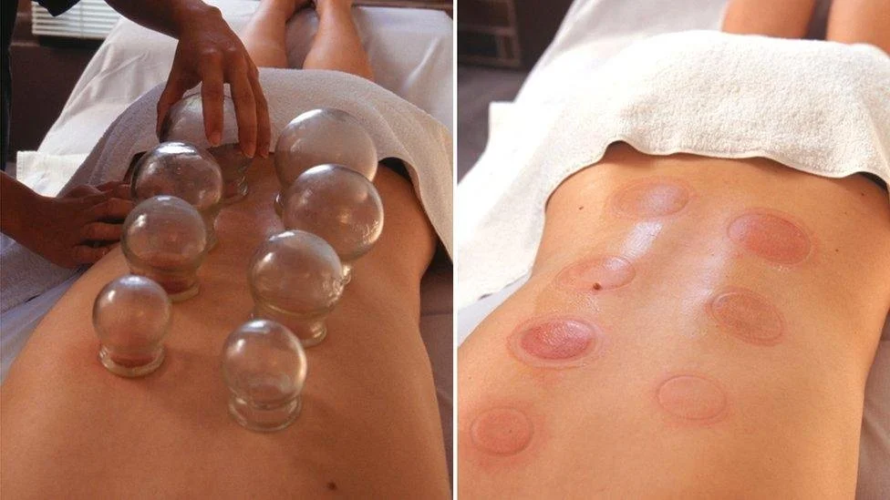 Cupping treatment with Acupuncture and chiropractic aftercare guide. What to expect post chiropratic treatment