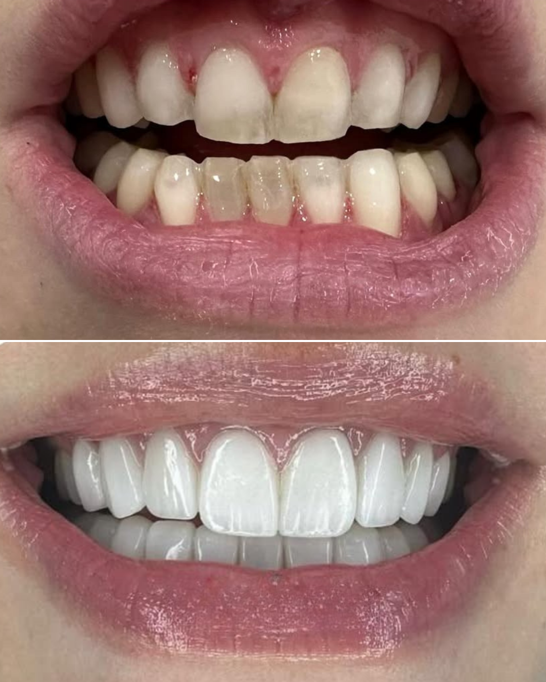 Vertaa ennen ja jälkeen hiontavapaat laminaatit, ennen hampaat ovat kellertävät ja epäsäännölliset, jälkeen hampaat ovat valkoiset ja tasaiset.