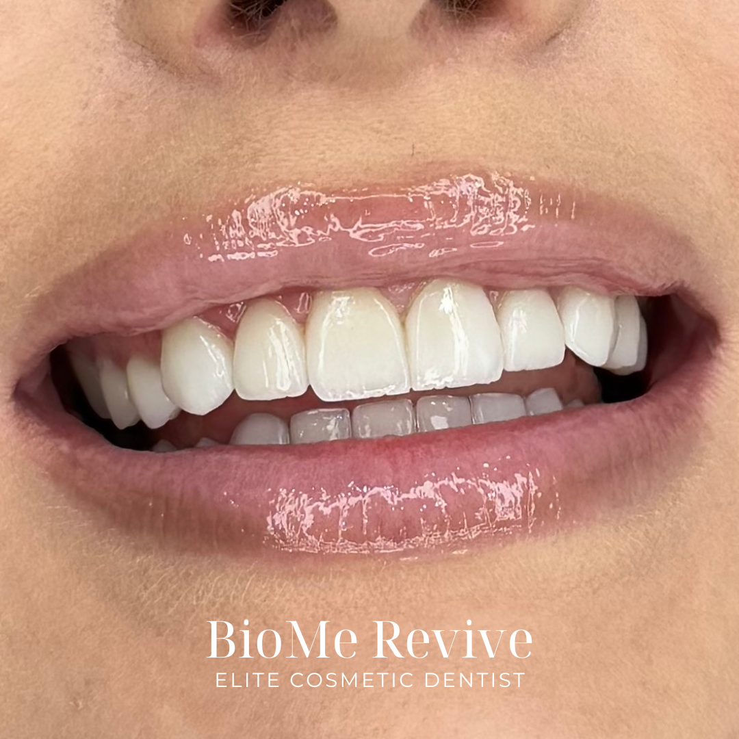Hymyilevä henkilö näyttää hoidetut, valkoiset hampaat ja huulien kiiltävän pinnan. Teksti bioMe Revive ja Elite Cosmetic Dentist on alareunassa.
