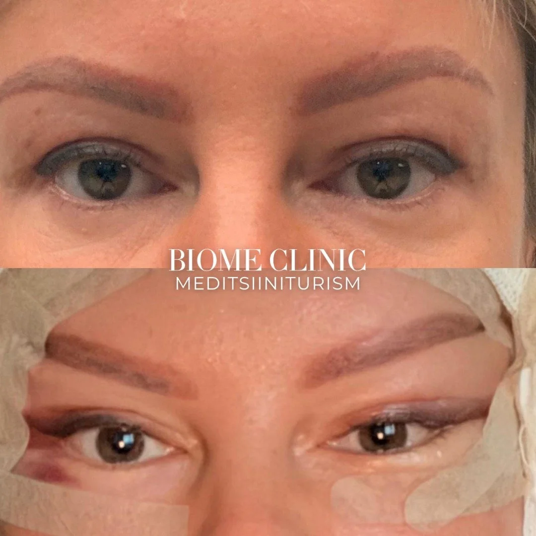 ✨ Endoskoopiline kulmude tõstmine – vaata vahet kohe! ✨Kulmud ja ülalaugude piirkond võivad vana.jpg