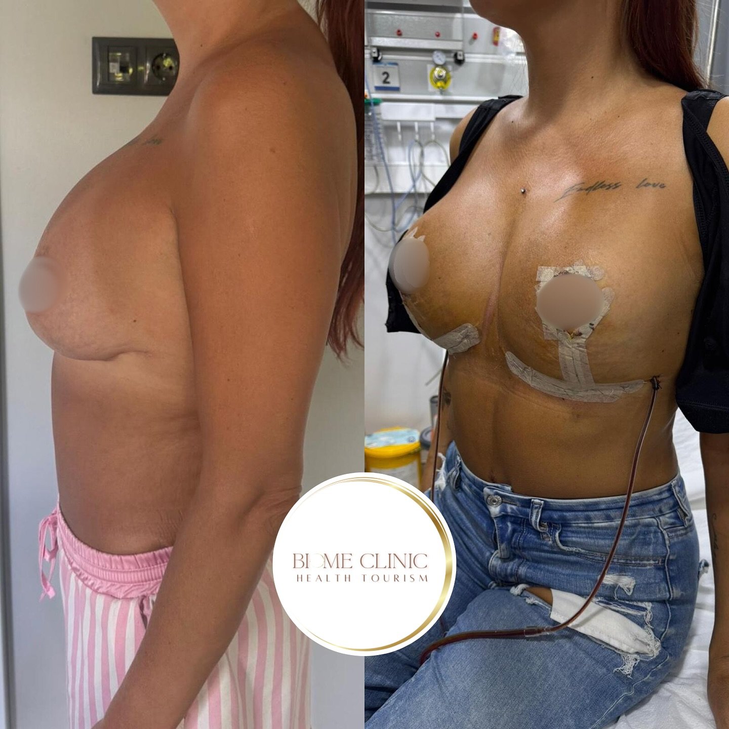 Me tegime seda taas! 😍 Eestis untsu läinud rinnaimplantaatide paigaldus sai korrigeeritud meie -2.jpg