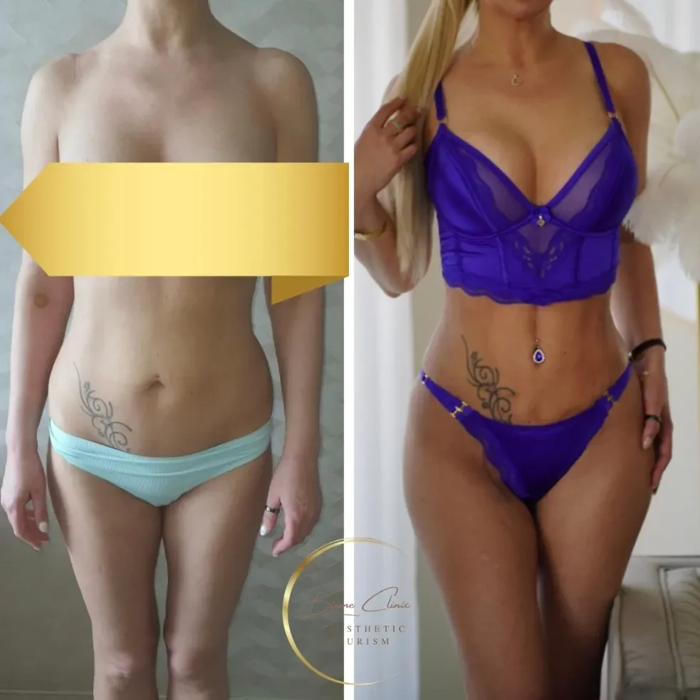 Keha kontuurimine Istanbulis, kerge ja elumuutev 🤍🇪🇪🇹🇷 Tulemus 2 nädalat peale oppi! Aitäh.webp