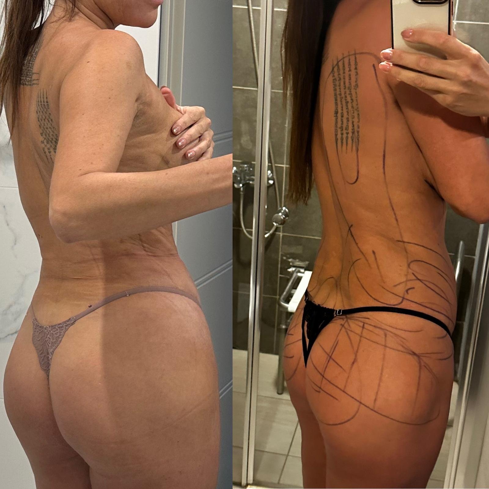 Nainen katsoo peiliin, toinen kuva hänen selästään, jossa on merkintöjä tattoo- ja kirurgialinjoista.